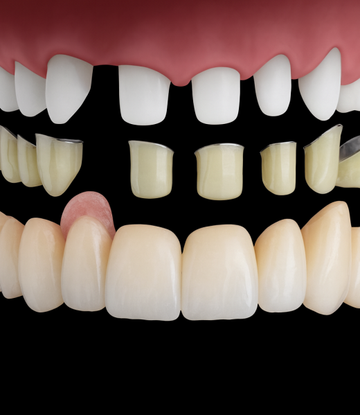 Zahnersatz ohne Implantate